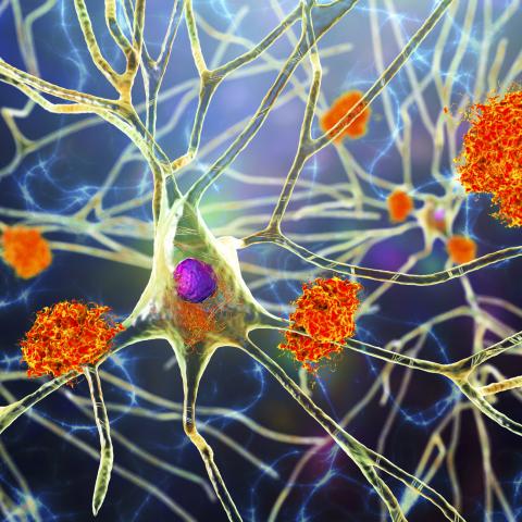 New blood test for Alzheimer's disease gets FDA approval