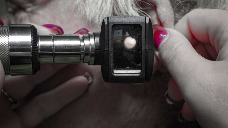 AI sniffs earwax and detects Parkinson’s with 94% accuracy