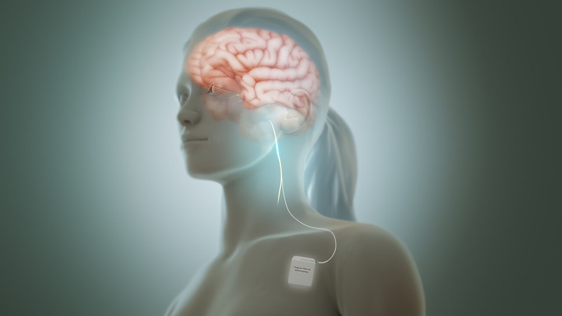 Implant provides lasting relief for treatment-resistant depression, study finds
