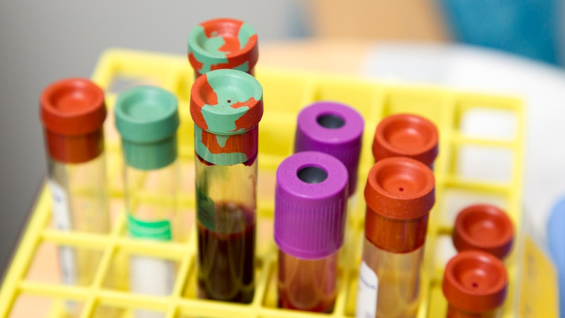 Alzheimer’s blood test around ages 53-69 may help detect early cognitive decline