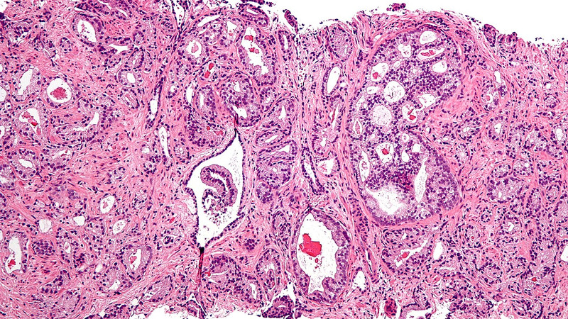 Scans That Make Prostate Cancer Cells ‘Glow’ Can Eliminate Invasive Biopsies and False Diagnoses