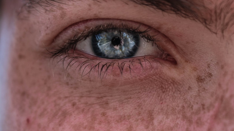 Diagnostic dilemma: A woman turned black and blue weeks after starting a new medication