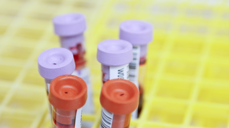 Study shows a blood test can help identify healthy people at high risk for Alzheimer’s disease
