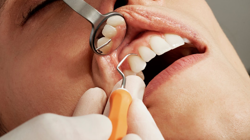 Scientists discover a hidden heart valve risk linked to gum disease