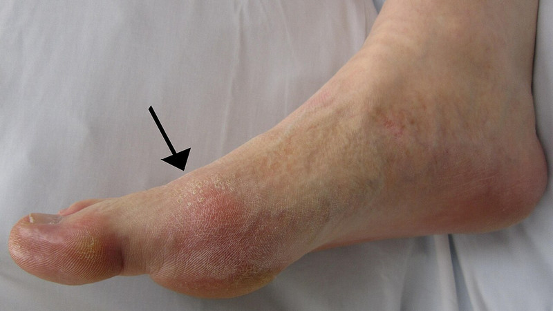 Young, Fit and Still at Risk of Gout – Why the Painful Condition Is on the Rise