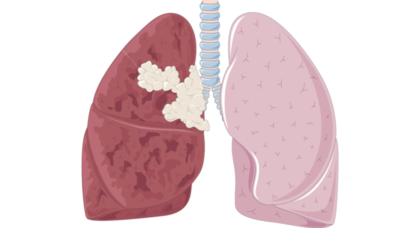 CUHK Discovers New Therapeutic Target for Lung Cancer, Bringing New Hope for Treatment