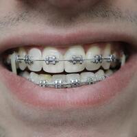 Understanding Orthodontic Relapse: Why Muscles Matter