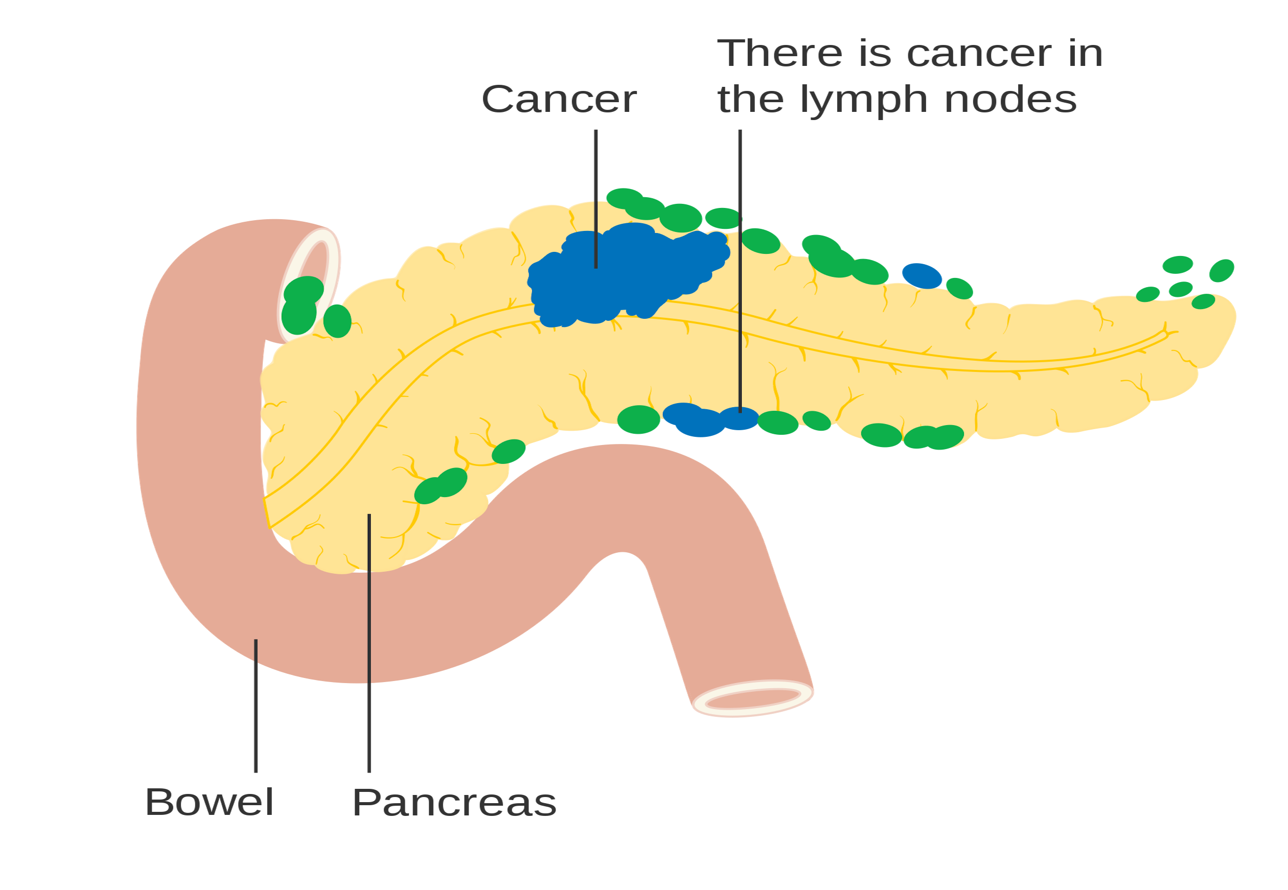 Cannabis Chemical May Have ‘Major Impact’ On Pancreatic Cancer Treatment