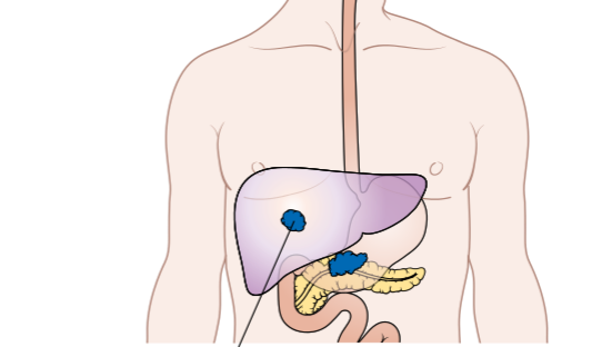 Study on cannabis chemical as a treatment for pancreatic cancer may have 'major impact,' Harvard researcher says