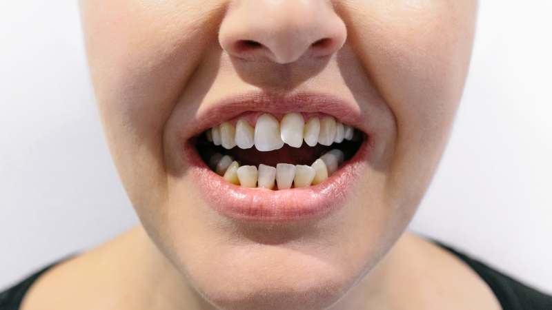 Man Gets Flesh-Eating Disease After A Relative Bit Him