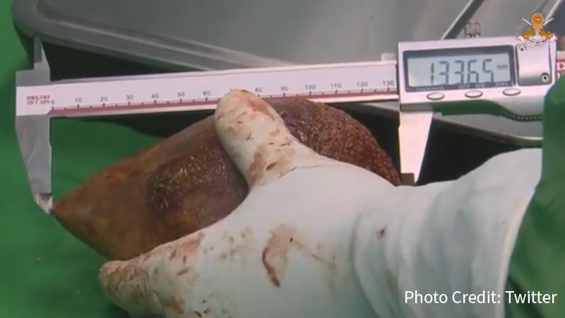 Doctors Remove World’s Largest Kidney Stone—It’s Comically Big!