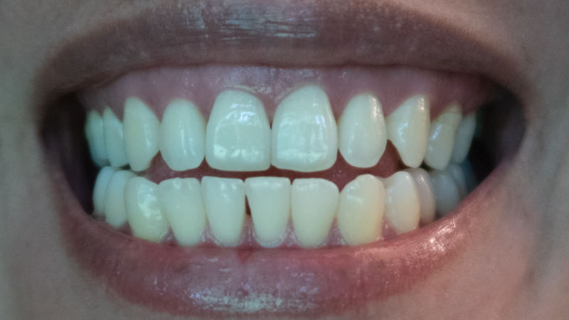 The Horrifying Case of “Exploding Teeth”