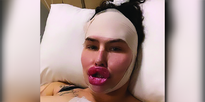 Woman Paid 50K For the Ugliest Lips You’ll Ever See