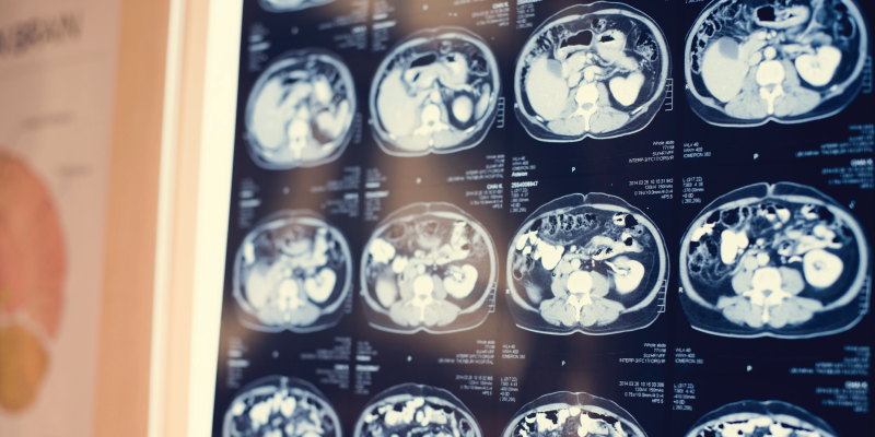 Woman Discovers She’s Been Living with a Needle Stuck in Her Brain Her Entire Life